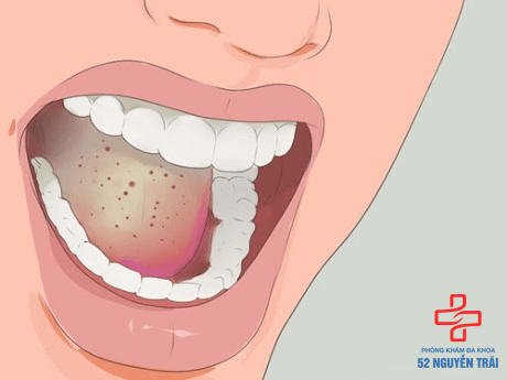 sùi mào gà có lây qua nước bọt không
