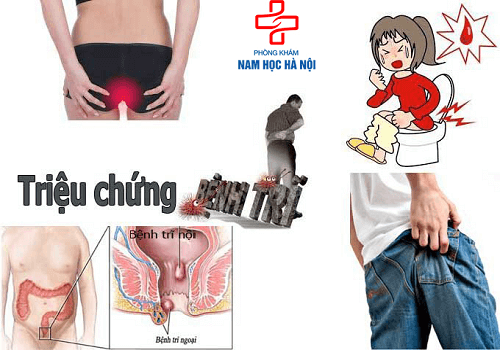 bệnh trĩ bệnh trĩ