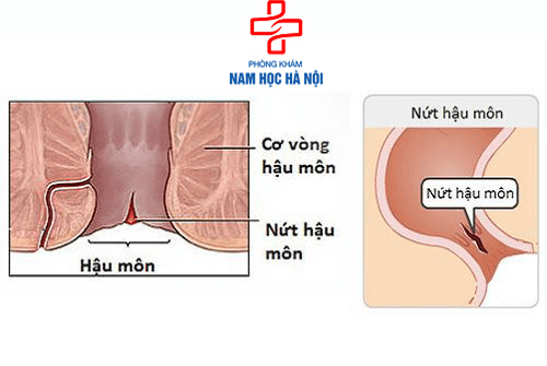 nứt kẽ hậu môn nứt kẽ hậu môn
