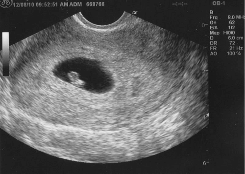 kết quả siêu âm thai 5 tuần
