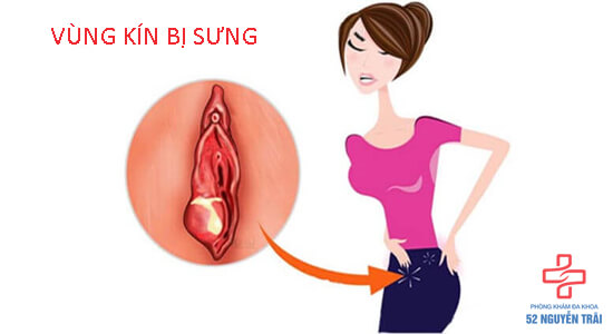 vùng kín bị sưng