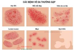 benh-da-lieu-thuong-gap